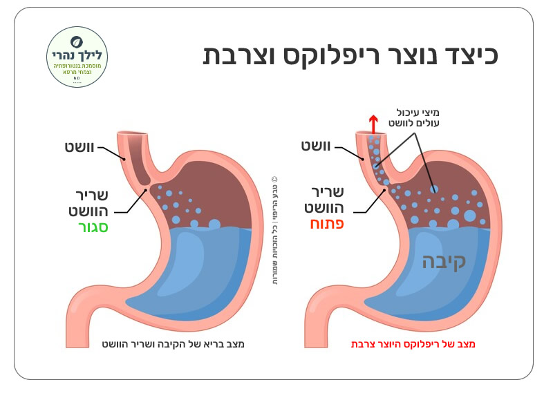 ליחה מרובה כחלק מתסמיני ריפלוקס