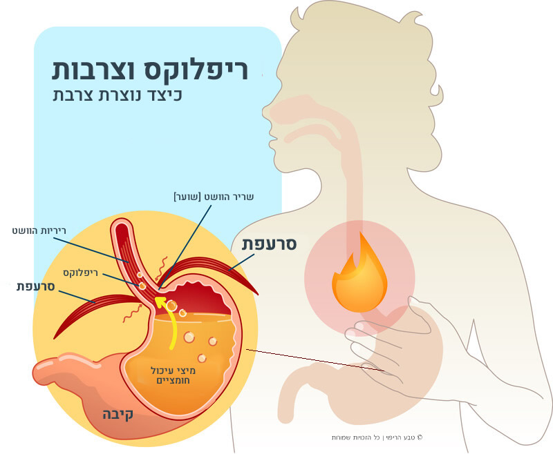 מה זה דלקת בוושט אזופגיטיס